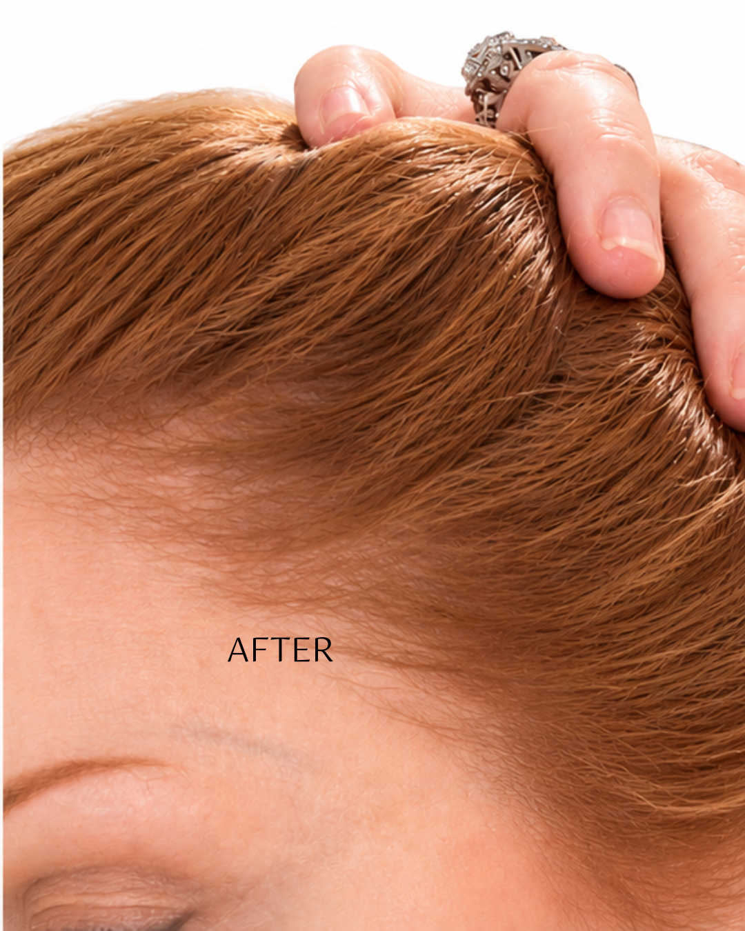 Close-up of a person's scalp and hairline with the word 'AFTER' overlaid, showing hair growth or coverage results. A hand with a ring is holding the hair upward.